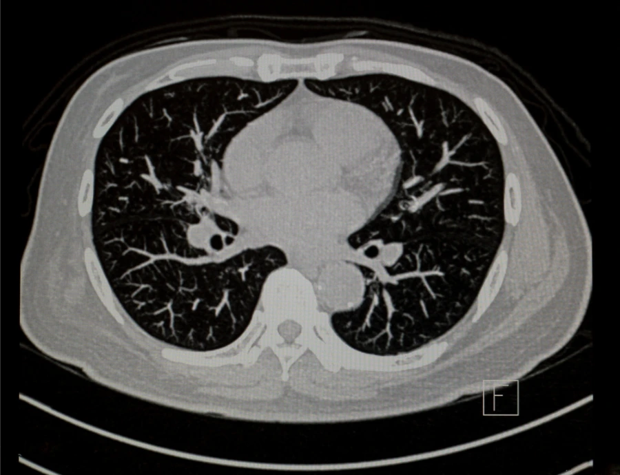 CT Low Dose Lung Screening (LDCT)